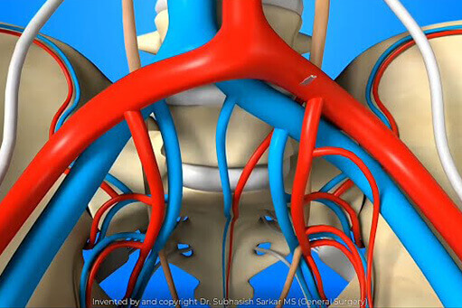 3D Medical Animation